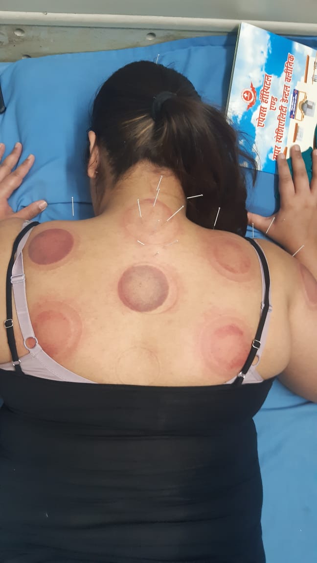 Acupuncture Classical