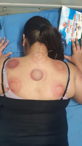 Acupuncture Classical