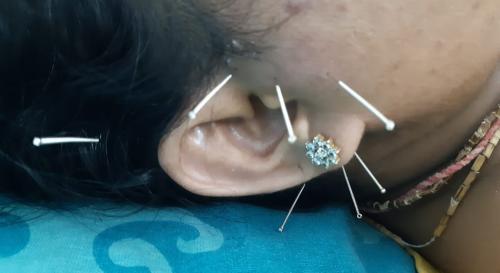 Auricular Acupuncture