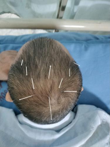 Scalp Acupuncture